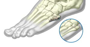 5th Metatarsal Fixation System