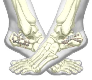 Calcaneal Fracture Fixation System