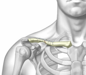 Clavicle Fixation System