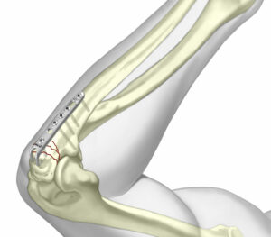 Elbow Fixation System