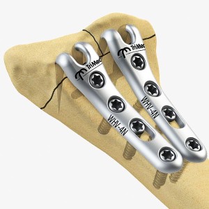 Wrist Fixation System