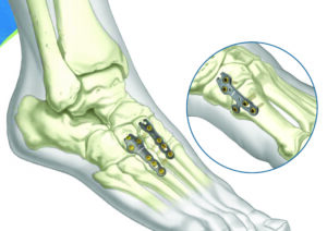 ASET Foot Plating System: Hooks