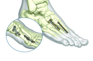 ASET Foot Plating System: Plates