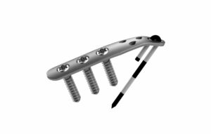 Dorsal Ulnar Pin Plate™