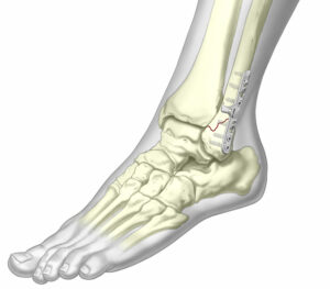 Ankle Fixation System